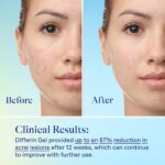 Differin Acne Skin Care Kit, Differin Gel Retinoid Acne Treatment for Face with 0.1% Adapalene & 5% Benzoyl Peroxide Face Wash & Body Wash, Designed for Pimple and Acne Prone Skin - Image 6