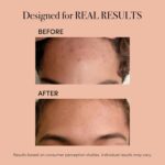 ReVive Clinical Acne Device, Red & Blue Light Wand for Breakouts, FDA-Cleared Acne Tools, 3-Minute Face Tools for Skincare, Plug-In Design - Image 4